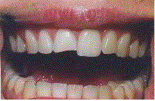 Resina de modelado dental: FlexiDent