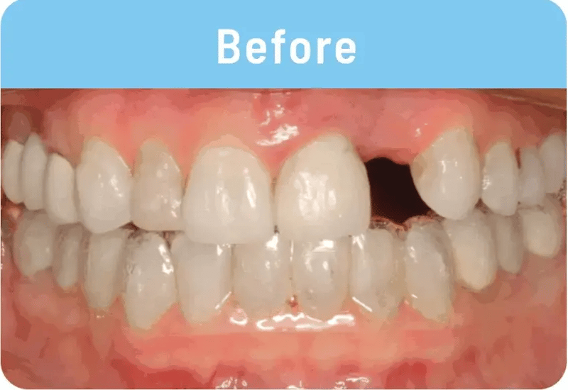 Resina de modelado dental: FlexiDent