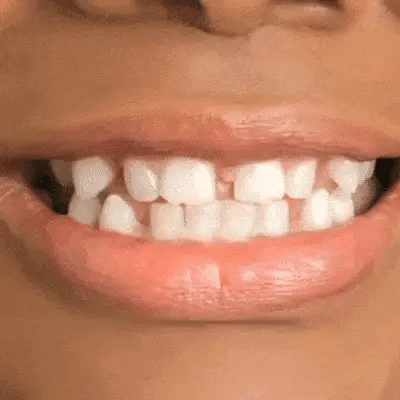 Resina de modelado dental: FlexiDent
